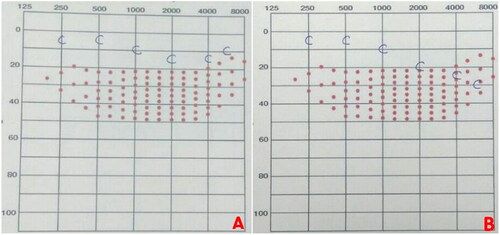 Figure 2. Post-operative audiogram of the patient (A: right ear; B: left ear). The results were better than the normal ‘speech banana’ (red dots), indicated that the ability to hear and understand speech improved remarkably.