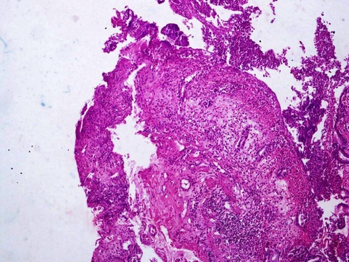 Figure 5 Ischemic colitis changes seen on a rectal biopsy. Magnification X4