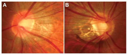 Figure 1 Optic disc photographs fulfilling our criteria of the typical tilt appearance. (A) A subject with Graves’ ophthalmopathy. (B) A subject with glaucoma, in which a nerve fiber layer defect is recognized around the inferior temporal position of the optic disc.