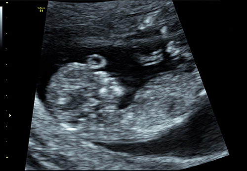 Figure 3 Two-dimensional ultrasound: a round, echoless appearance in the center of the fetal forehead.