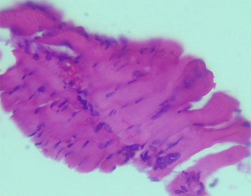 Figure 2 Muscle biopsy of dermatomyositis in thyroid cancer patient at University of Gondar Hospital.