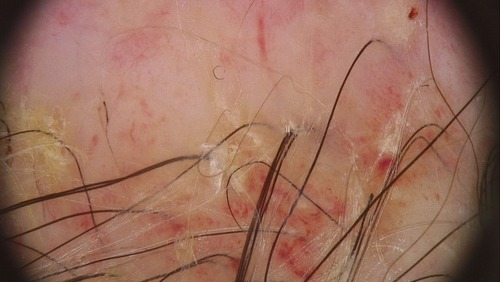 Figure 6 Trichoscopy of chronic EPDS where there is evident marked atrophic skin, lack of follicular ostia, and follicular yellow thick exudate.