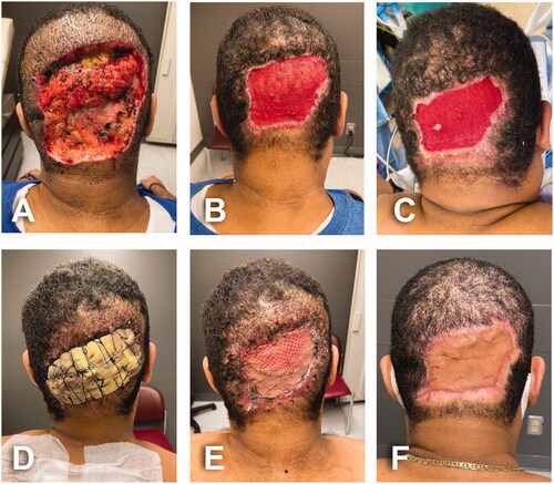 Figure 2. Post-excisional course. (A) Postoperative day 4; first postoperative assessment in outpatient clinic. (B) Postoperative day 39; open wound getting significantly smaller, more superficial and well vascularized. (C) Postoperative day 49; local condition during the second surgical procedure. Open area still reducing in size, smooth and well vascularized granulation tissue with small area of epidermal cells spreading out on surface. (D) Six days after second surgery with the bolster dressing in place. Skin graft was harvested from upper back. (E) Meshed split thickness skin graft after dressing removal the same day. (F) Long term follow-up 3 months after skin graft.