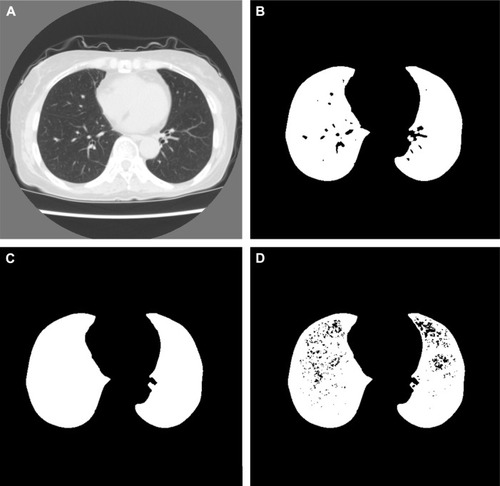 Figure 2 Representative images of computed tomography (CT) image and results of preprocessing.