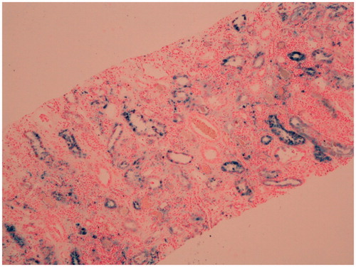 Figure 2. Widespread hemosiderin deposition in tubular epithelial cells (Prussian blue stain ×40).