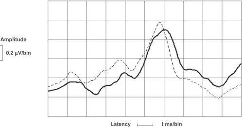 Figure 2 Averaged ABRs with forward masking stimulus for male subjects with Asperger syndrome (n = 5; soild line) and matched healthy controls (n = 5; dotted line).