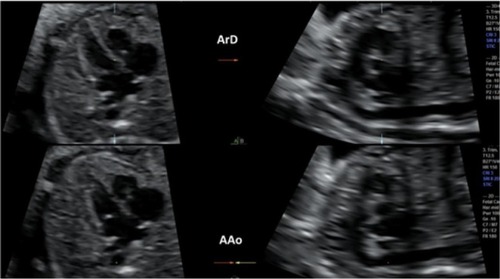 Figure 2 Technique of Espinoza et alCitation21 for obtaining the aortic and ductal arches from the four-chamber plane of volumetric acquisition of spatiotemporal image correlation. With axial plane A positioned with the cardiac base close to 6 o’clock, the ductal arch is viewed in the sagittal plane when the reference point is positioned at the crux of the heart. The aortic arch is viewed in the sagittal plane when the reference point is moved to the descending aorta.