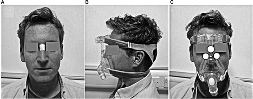 Figure 1 (A) The location of the Sebutape on the bridge of the nose pre- and post-mask applications. (B) Graduated marks (white vertical lines) placed on the straps of the mask to incrementally increase the strap tension. (C) Location of Talley pressure monitoring cells on the nose and cheeks.