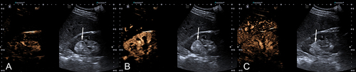Figure 2 A male patient with renal angiomyolipomas (arrows) under CEUS (dual layout). (A) Synchronous-in at 11th sec. (B) Heterogeneous isoenhancement at 14th sec. (C) Synchronous-out at 69th sec.
