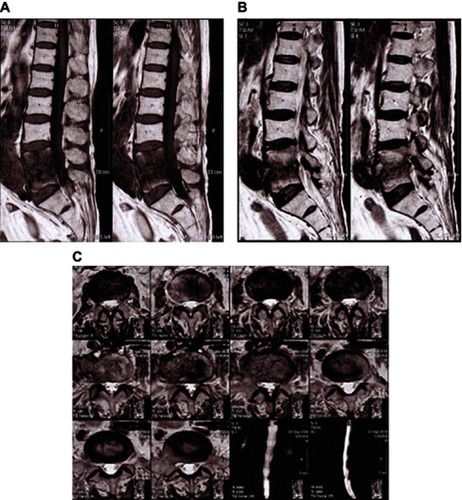 Figure 1 Lumbosacral spine magnetic resonance imaging. Sagittal T1W view of T12-L5 (A), Sagittal T2W view T12-L5 (B), and axial view of L3-L5 (C).