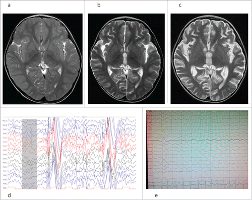 Figure 1. MRI T2 section and EEG of the patient. (a) MRI on admission, (b) MRI after the first month in hospital, (c) MRI after the second months, (d) EEG on admission, (e) EEG after the second months.