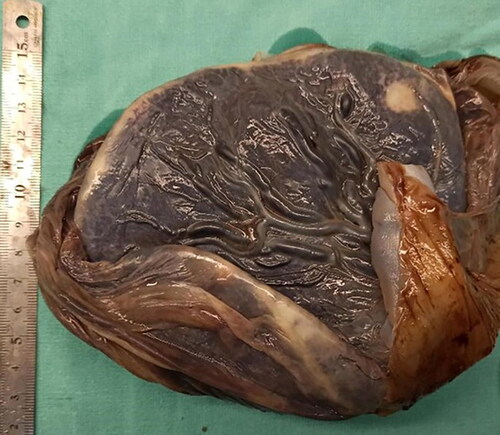 Figure 1. Hypoplastic placenta of a preeclamptic pregnancy.