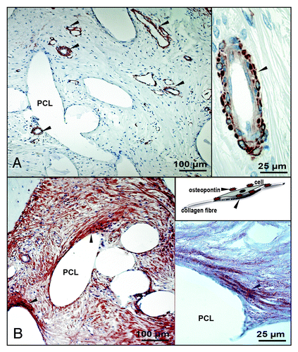 Figure 8. Anti-α smooth muscle actin and osteopontin staining: detailed investigation. (A) Anti- α smooth muscle actin (1A4) staining (brown), nuclei are counter stained in blue, left: general overview, vessels are marked with a black arrow; right: smooth muscle cells in vessel walls. (B) Osteopontin staining (brown), nuclei are counter stained in blue, black arrow marks positively stained cell-collagen-osteopontin bonds, left: general overview; right: osteopontin associated cell-collagen fiber construct, in vivo situation is schematically drawn in the upper right picture; (original magnification A, B-100x).