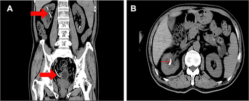 Figure 4 (A) In the CT window, the red arrows point to the DJ tubes placed in the kidneys and bladder (B) in different slices of the CT window, the DJ tube of the kidney is indicated by the red arrow.