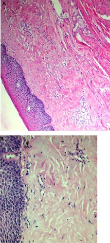 Figure 10 Histopathological picture showing advanced stage of oral submucous fibrosis.