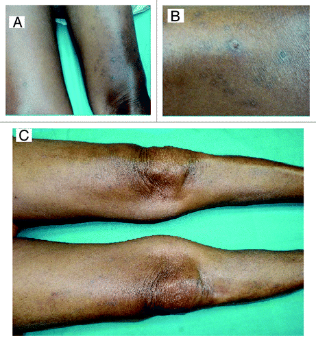 Figure 1. (A) Pigmented nodularlesions seen on both thighs with central keratinous plug. (B) Close up demonstrating nodular lesion with central crater. (C) Picture of both thighs (10 mo after diagnosis) showing complete resolution of lesions with presence of hyperpigmentation.