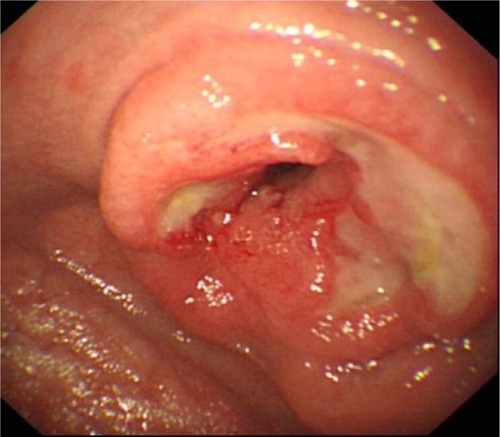 Figure 2 An endoscopic image of T-cell lymphoma (EATL).