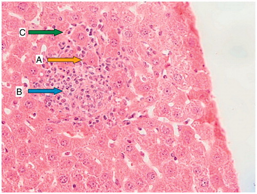 Figure 2. CP group (200 mg/kg); a liver section of a mouse showing necrotic hepatocytes with small crushed nuclei (A; yellow arrow), a portal space with severe inflammation (B; blue arrow), and hepatocytes surrounded by lymphocytic infiltration (C; green arrow).