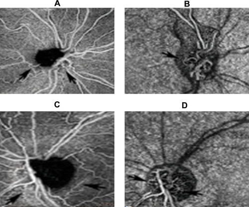 Figure 3 OCT-A images of a patient with Leber hereditary optic neuropathy.