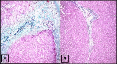 Figure 1 Trichrome staining for collagen in human biliary atresia. Trichrome staining was done as described in the Materials and methods section. A) Thick bands of collagen septa (green) separating nodular liver tissue. B) Trichrome staining of a healthy control liver (original magnification ×10).