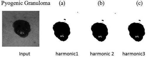 Figure 5. PCNN harmonics of dermoscopic lesion.