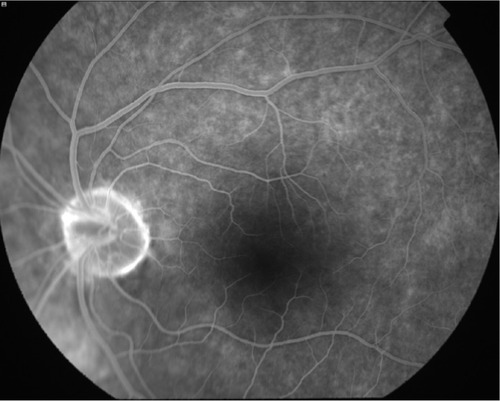 Figure 4 Fluorescein angiography showing no abnormalities.