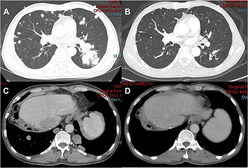 Figure 3 CT scan results of the changes for target lesions in the lung site of the CR patient with advanced hepatocellular carcinoma before (A) and after (B) the administration of lenvatinib plus sintilimab. CT scan results of the changes for target lesions in the liver site of the CR patient with advanced hepatocellular carcinoma before (C) and after (D) the administration of lenvatinib plus sintilimab.