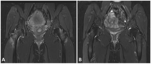 Figure 1. Coronal T2-W sequences of the pelvis of a 32 years old female, 1 week after vaginal delivery, with severe bilateral hip pain (A) and a follow-up image performed after 3 months (B). On presentation, there is bilateral bone marrow edema of the femoral head and neck (more severe on the right) compatible with bilateral transient osteoporosis (A). After 3 months there is almost complete resolution of the bone marrow edema with minor residual bone marrow edema on the right femoral head (B).