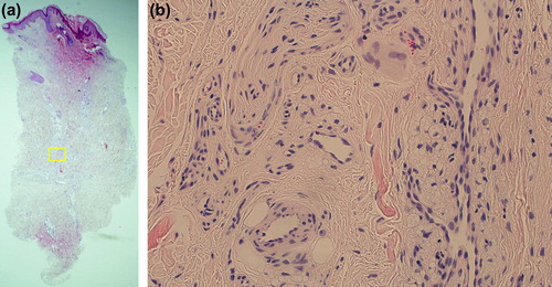 Figure 2. (a) On histology, we can see increased fibrosis with an apparent increased dermal thickness. (b) The main pathological findings are overt granulomatous response to foreign substances with mononuclear cells, lipid laden macrophages, and foreign-body giant cells. Spherioles of washed out artifact confirms former presence of an oily substance. Hematoxylin and eosin, original magnification (a) × 40; (b) × 400.