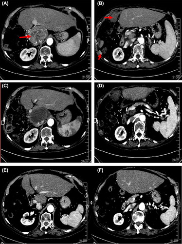 Figure 1. Patient 3. (A, B). In August 2007 CT scan evaluation showing a recurrence in the liver (A) and in the peritoneum (B). (C, D). A complete radiological response (mRECIST criteria) was observed in November 2007 after 3 months of sorafenib. (E, F). In October 2012, the patient was still alive without any lesion on the CT scan, 54 months after cessation of sorafenib.