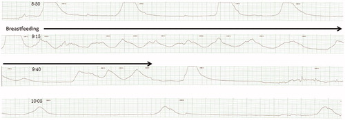 Figure 2. Time of the placental delivery was 8:39. This 33-year-old primiparous woman had good uterine contractions and her measured total blood loss was 201 g. This woman had skin-to-skin contact with her baby during the first hours after birth. Around 30 min after the delivery of placenta, breastfeeding was initiated. During breastfeeding, her contraction intervals become frequent. The rate of paper feed was 3 cm/min.