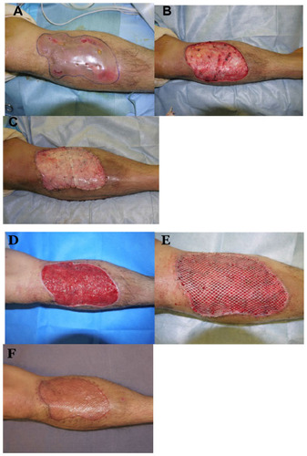 Figure 1 (A) Nonhealing chronic pyoderma on the right lower limb before wound debridement. (B) After debridement. (C) Application of the collagen matrix after debridement. (D) Robust granulation tissue 2 weeks after collagen matrix application. (E) Split-thickness mesh skin grafting was performed. (F) Healed wound 3 months after grafting.