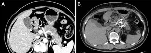 Figure 4 The patient is a 62-year-old female, who had carcinoma in the body and tail of the pancreas.