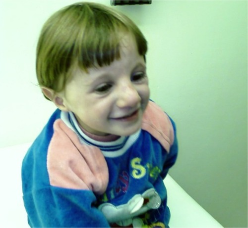 Figure 3 Prematurely aged appearance of the proband when she smiles.
