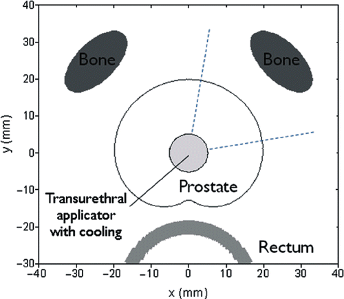 Figure 3. Geometry of the biothermal simulation model with a transurethral ultrasound applicator within the prostatic urethra, the prostate of the variable dimensions the rectum with endorectal cooling, and a simplified representation of pubic bones at variable distance from the prostate capsule. The intended target zone for the simulations is demarcated as a ∼90° sector quadrant of the prostate centered around a peluic bone.