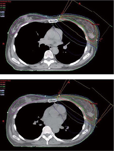 Figure 2. The reduced lung and cardiac and increased medial sternum dose as a result of decreased lung density in DIBH plan (upper panel) compared to the FB plan (lower panel).