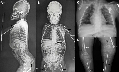 Figure 1 Skeletal radiographs of the patient. (A and B) Mild scoliosis and intramedullary rods in the long bones (black arrows). (C) Thorax CT-scan, and (D) Intramedullary rods (white arrows), diaphyseal bowing (dashed arrows), and osteopenia (black arrow).