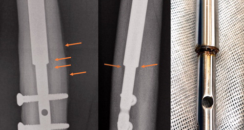 Figure 1. A removed nail. Osteolysis, periosteal reaction, and discoloration (potential corrosion) are evident 315 days after index surgery. Please refer to the Supplementary data for other examples.