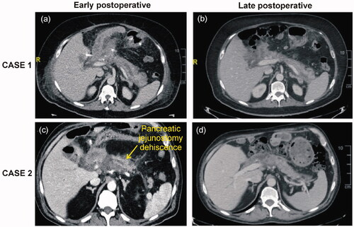 Figure 2. Early (a,c) and late (b,d) postoperative CT scans of cases 1 (a,b) and 2 (c,d).