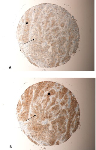 Figure 7. Represents two sections taken from the same tumour, a grade 2 OSCC from the tongue, on the microarray. (A) beta-Catenin staining; (B) SALL4 staining. Significant overlap in the expression of SALL4 and beta-Catenin in the same tumour cells could be seen (thin arrows, (A) and (B)). Predominanty nuclear and cytoplasmic expression in the tumour cells for both markers (arrow heads, (A) and (B)) could be seen. (Magnification X10).