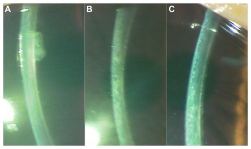 Figure 5 (A) cross sectional appearance of corneal stroma at 3 months; (B) cross sectional appearance of corneal stroma at 6 months; (C) cross sectional appearance of corneal stroma at 1 year.