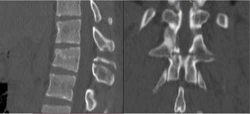 Figure 2 Sagittal and coronal CT scan images: Subtype B1 injury (Chance fracture). This 23-year-old man fell from a height. He was neurologically intact and complained of severe back pain.