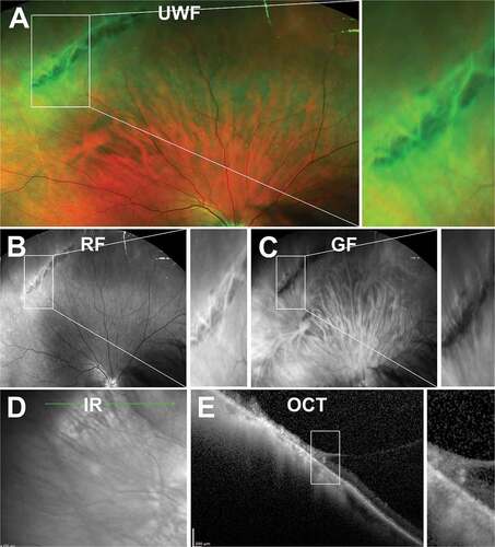 Figure 11. A 60-year-old East Asian male with lattice degeneration in the superior-temporal peripheral retina of the right eye. (A) UWF imaging highlights an oval-shaped area of whitened retina with irregular borders and internal RPE hyperplasia and (B) red-free and (C) green-free imaging suggests that the internal hyperpigmentation is located in the RPE layer with no choroidal involvement. (D) Infrared imaging demonstrates irregular reflectivity in the region of degeneration and shows the orientation of the lesion to be largely parallel to the ora serrata and (E) peripheral OCT, with the line scan orientated radially through the lesion, highlights the overlying vitreoretinal attachment at the anterior and posterior aspects and shows a retinal break at the anterior edge of the lesion, internal disorganisation of the retinal layers, and irregular hypo-reflectivity in the outer retinal layers likely related to the overlying vitreoretinal traction. Abbreviations as in Figure 3.