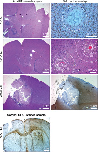 Figure 4. Rat brain histology: The left column shows HE stained axial tissue samples at depth 3 mm (z = 3). The electrodes were deployed orthogonal to the sample plane. White arrows point at selected electrode marks. The right column shows magnifications, including overlays of calculated iso-field lines at selected intensities (in V/cm). Samples are NF stained (neurofilament), HE stained and GFAP stained (glial filament), from top to bottom. GFAP stained coronal tissue sample: Generally the tissue is recovered and scar tissue (reactive gliosis) is seen only in close proximity of the electrode (arrow) where the electric field intensity is very high. In the superior part of the brain there is a slightly diffuse reactive gliosis connected to surgery of the brain dura and penetration of the device.