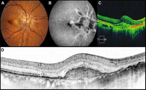 Figure 1 Case 3. Forty-seven-year-old female who complained of metamorphopsia and decrease of visual acuity as chief complaint.