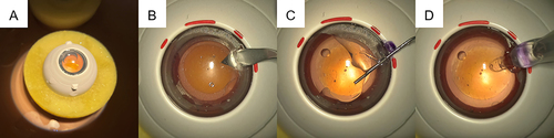 Figure 1 Plastic eye model set-up. (A) The plastic eye was placed under a surgical microscope for filming. (B) An incision was made at the base of the cornea. (C) The anterior chamber was filled with either dispersive or cohesive OVD at the desired temperature. (D) The IOL was injected and unfurling was recorded for review by three independent blinded adjudicators.