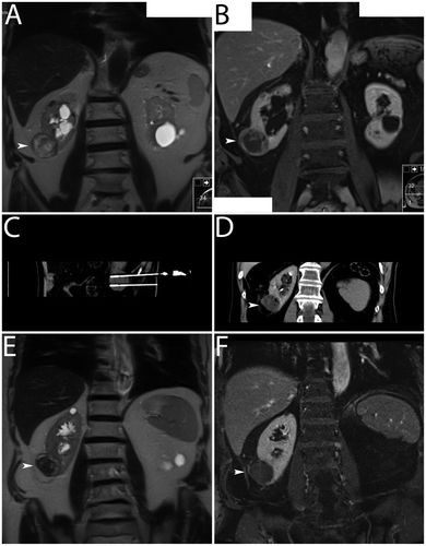 Figure 2. Clinical example. Multipolar RF ablation with two applicators was performed in a T1a renal cell carcinoma. (A, B) Dynamic MRI (T2w coronal image and T1w coronal image) for the diagnosis of a renal cell carcinoma with an exophytic tumour in the lower segment of the right kidney showing peripheral nodular contrast-enhancement (white arrowheads). (C) CT (curved maximum intensity projection) for documentation of correct positioning of the applicators (active tip lengths of 40 mm) – note exact parallel positioning of the applicators with a distance of approximately 20 mm. (D) CT (transverse image) directly after multipolar RF ablation – note regular hyperacute appearance of the coagulation with gas bubbles within the treated tumour (white arrowhead). (E, F) Dynamic MRI (T2w coronal image and T1w coronal image) one month after multipolar RF ablation without evidence of local recurrence – note signs of complete tumour destruction without suspect contrast-enhancement (white arrowheads).
