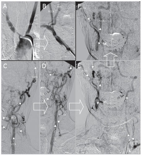 Figure 1 Transfemoral digital subtraction angiography of the stenosed brachiocephalic trunk (BCT) and of the left common carotid artery (LCCA) before (A) and after (B) stent assisted angioplasty. The complex pattern of collateral flow is depicted in C-F: 1) to the left vertebral artery (VA) via a left sided subclavian steal with flow reversal of the ascending cervical artery (asc. ca) and thyrocervical trunk (TCT) and 2) to the contralateral internal carotid artery (RICA) via numerous collaterals from the left external carotid artery (LECA) crossing the midline such as the left and the right superficial temporal artery (LSTA and RSTA). The direction of blood flow is indicated by arrows. Large arrows indicate chronological order.