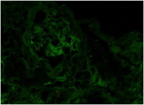 Figure 6. Immunofluorescence with pronase digestion on formalin-fixed paraffin-embedded tissue shows bright staining for kappa (400 × original magnification).