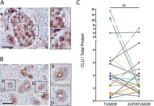 Figure 1. Clusterin expression in luminal breast cancer samples. A and B. Clusterin expression was analyzed by immunohistochemistry in tumoral (a) and juxtatumoral (b) tissues. Representative pictures are shown (n = 3, bars: 50 µm). C. Clusterin expression was quantified in tumor samples and their juxtatumoral counterparts by ELISA. Results are expressed as the amount of clusterin/total protein (µg of clusterin/mg of total protein, n = 21, ns = no statistically significant differences, p = .31).